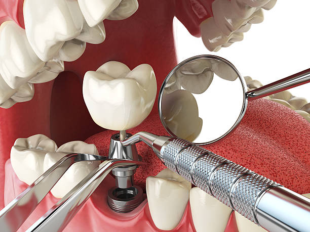Best Emergency Dental Care for Broken or Chipped Teeth in Gerdine, AL